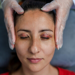 Portrait of Young woman who had blepharoplasty Eye Lid Surgery