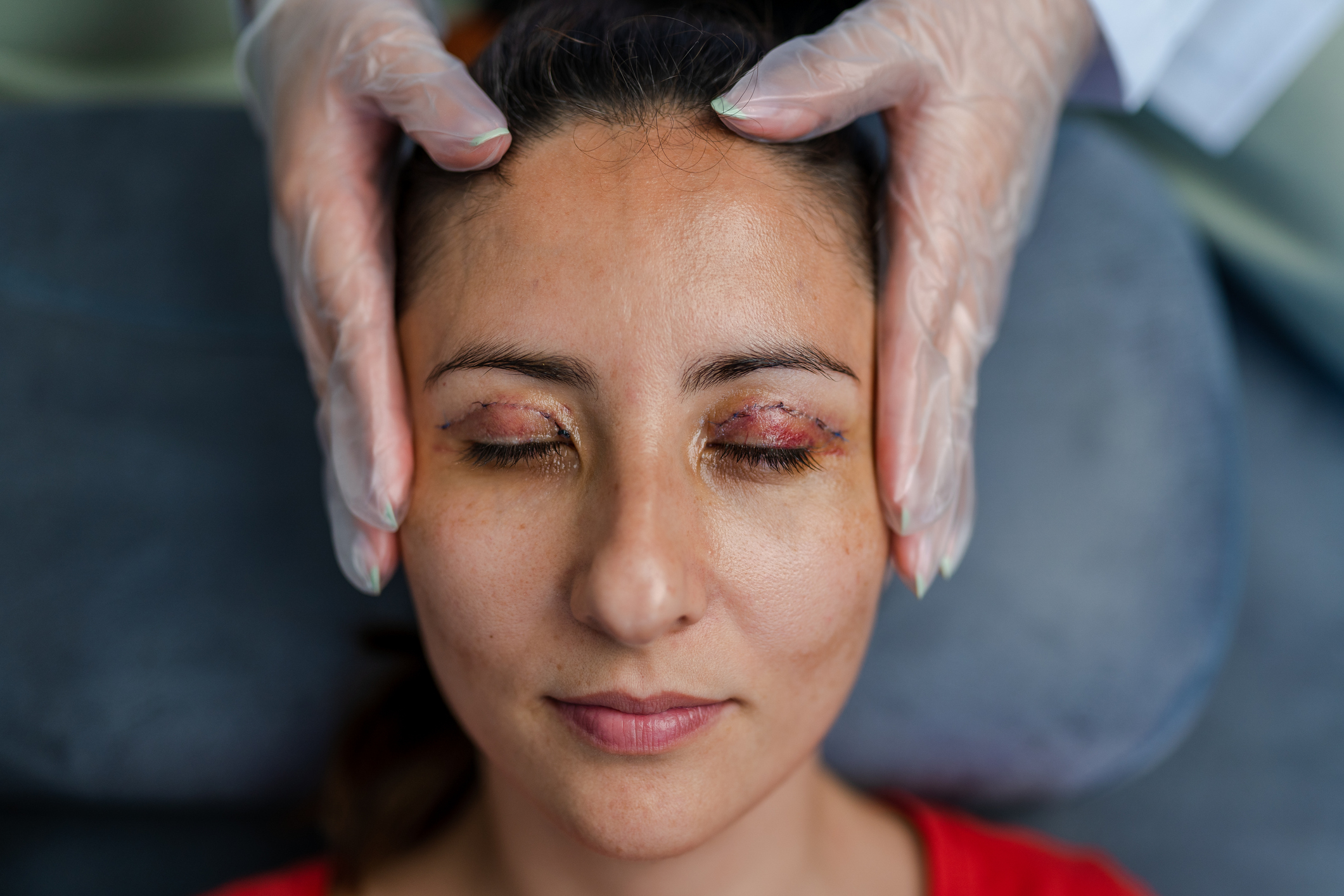 Portrait of Young woman who had blepharoplasty Eye Lid Surgery