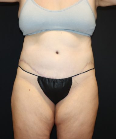 Abdominoplasty AFTER