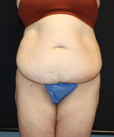 Abdominoplasty BEFORE