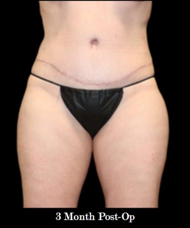 Abdominoplasty with lipo to flanks AFTER front