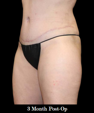 Abdominoplasty with lipo to flanks AFTER side