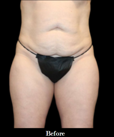 Abdominoplasty with lipo to flanks BEFORE front