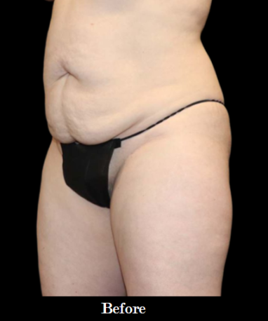 Abdominoplasty with lipo to flanks BEFORE side