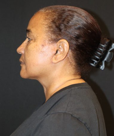 Facelift after side