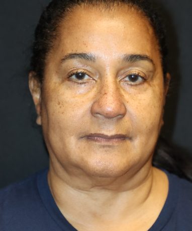 Facelift before