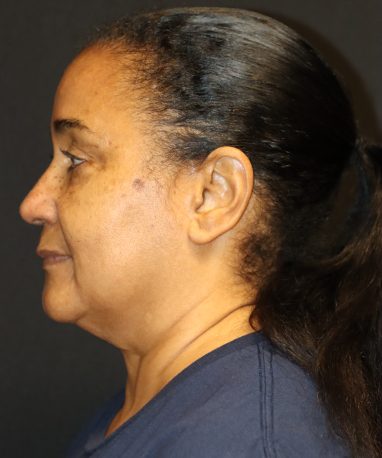 Facelift before side